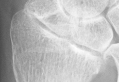 DistalRadius.bmp